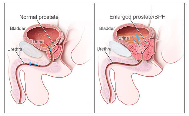 Zväčšená prostata - benígna prostatická hyperplázia (BPH)