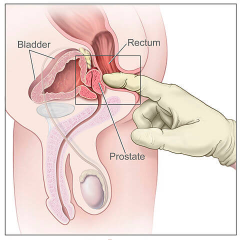 Rektálne vyšetrenie prostaty